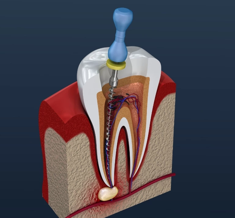 endodoncja