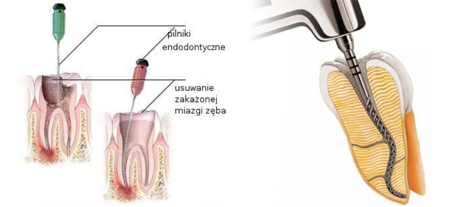 leczenie kanałowe