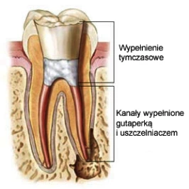 leczenie kanałowe 2