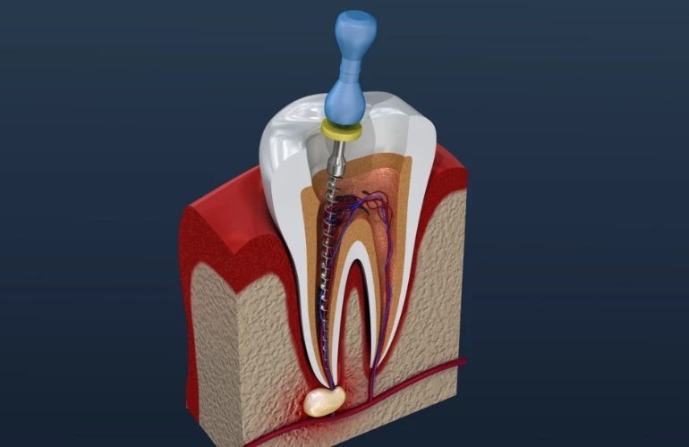 zabieg endodoncji