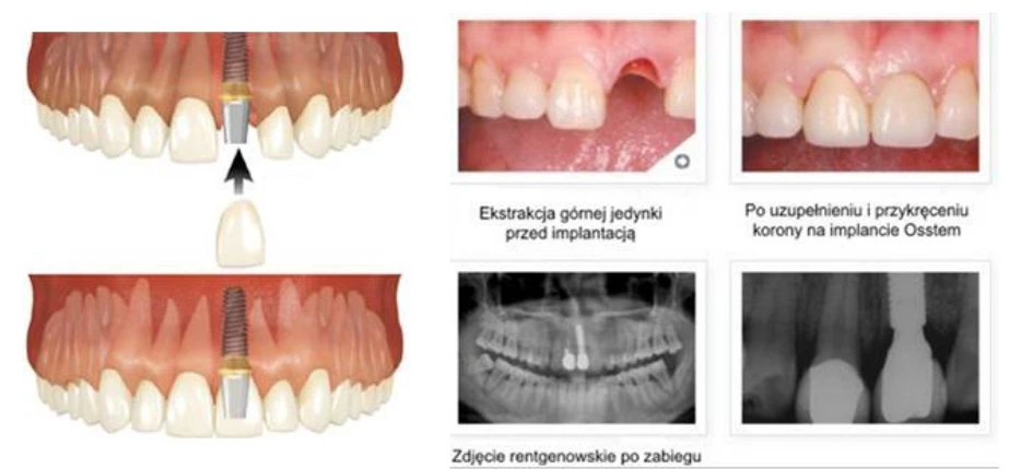 zastąpienie pojedynczego zęba