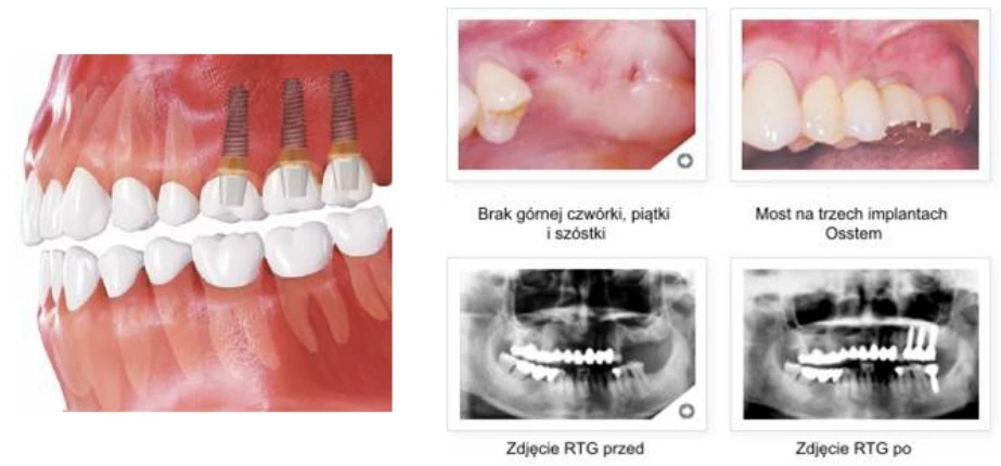 zastąpienie kilku zębów