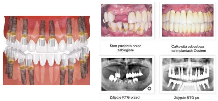 zastąpienie wszystkich zębów