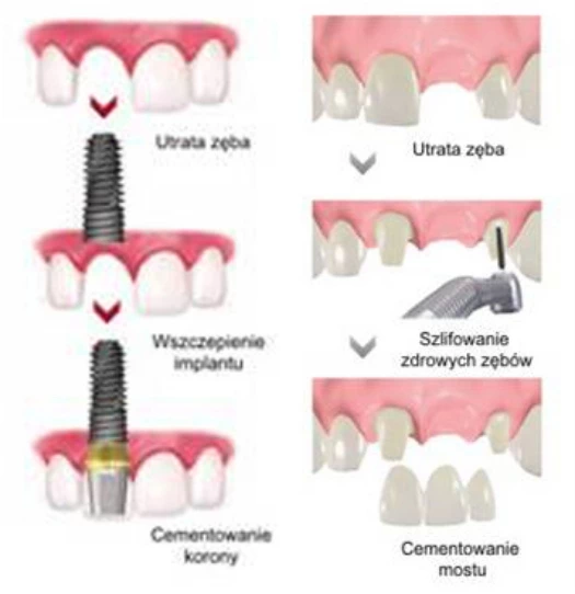 montaż implantu